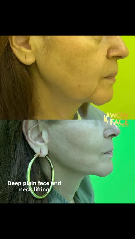 Before and after — Dr. Sabuhi Abilov