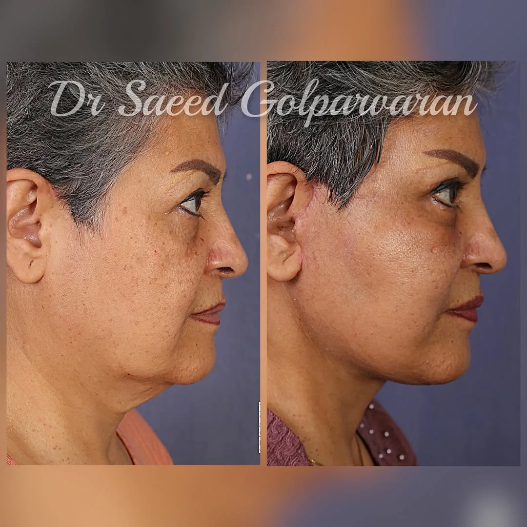 Before and after — Dr. Saeed Golparvaran