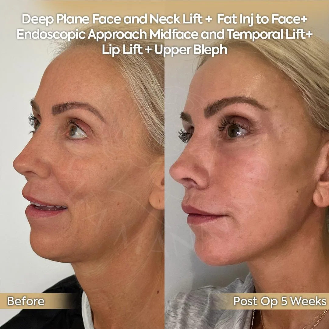 Before and after deep plane facelift — 58-year-old woman, right profile view, 5mo post-op by Dr. Safa Manav