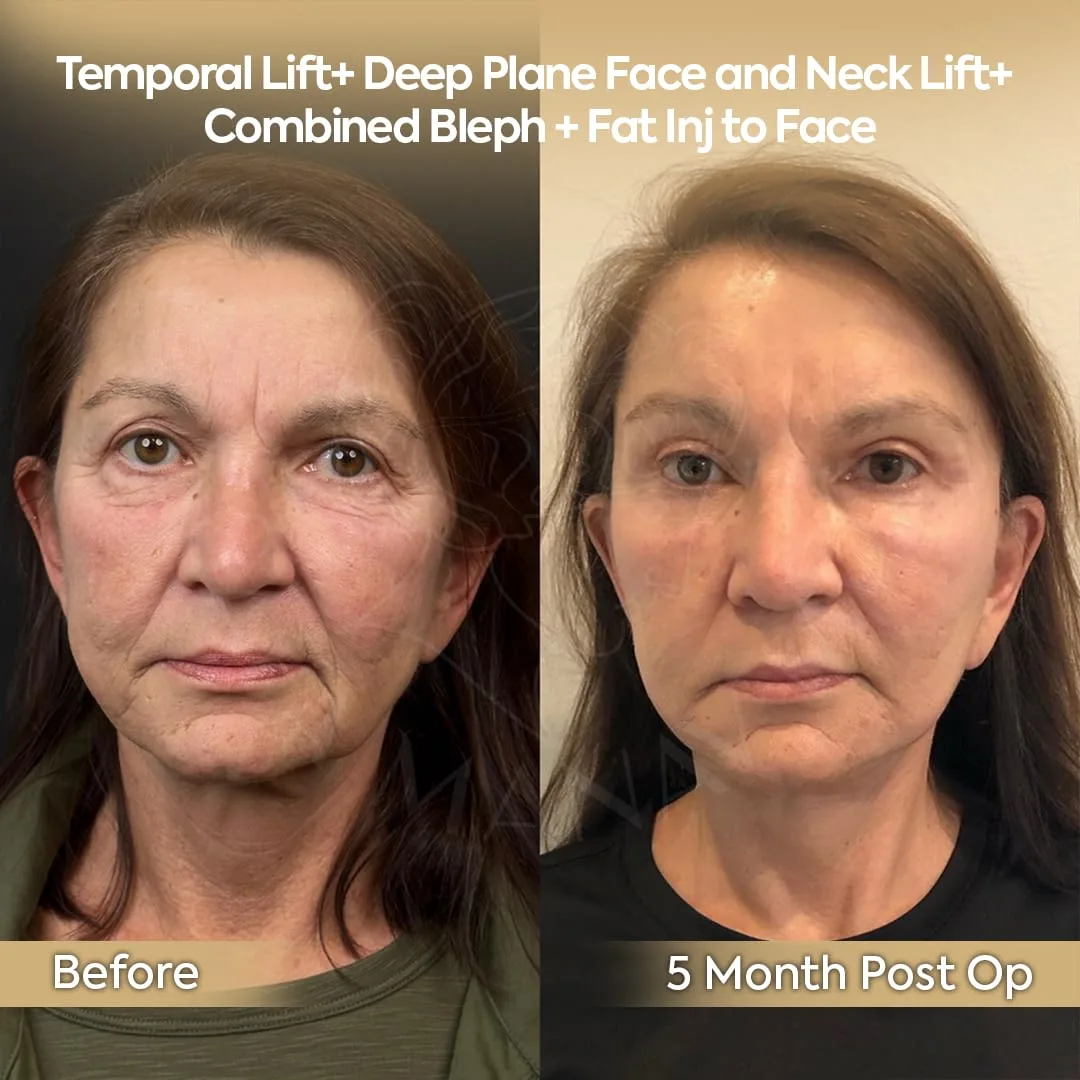 Before and after deep plane facelift — 58-year-old woman, frontal view, 5mo post-op by Dr. Safa Manav