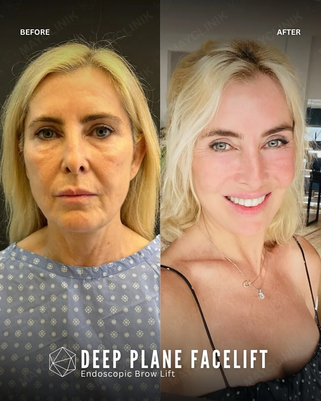 Before and after deep plane facelift — 52-year-old woman, frontal view, 6mo post-op by Dr. Şafak Çakır