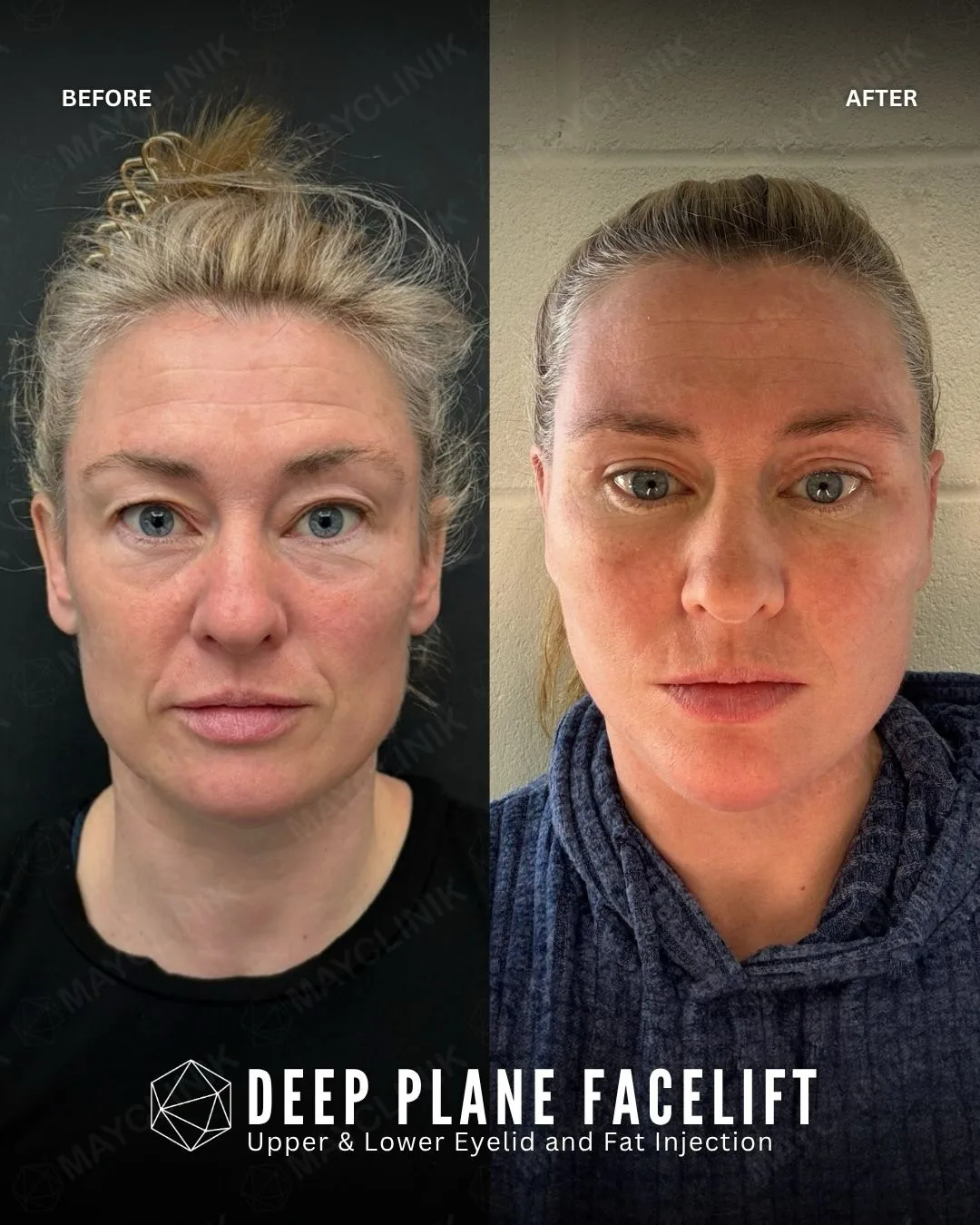 Before and after deep plane facelift — 45-year-old woman, frontal view, 1mo post-op by Dr. Şafak Çakır