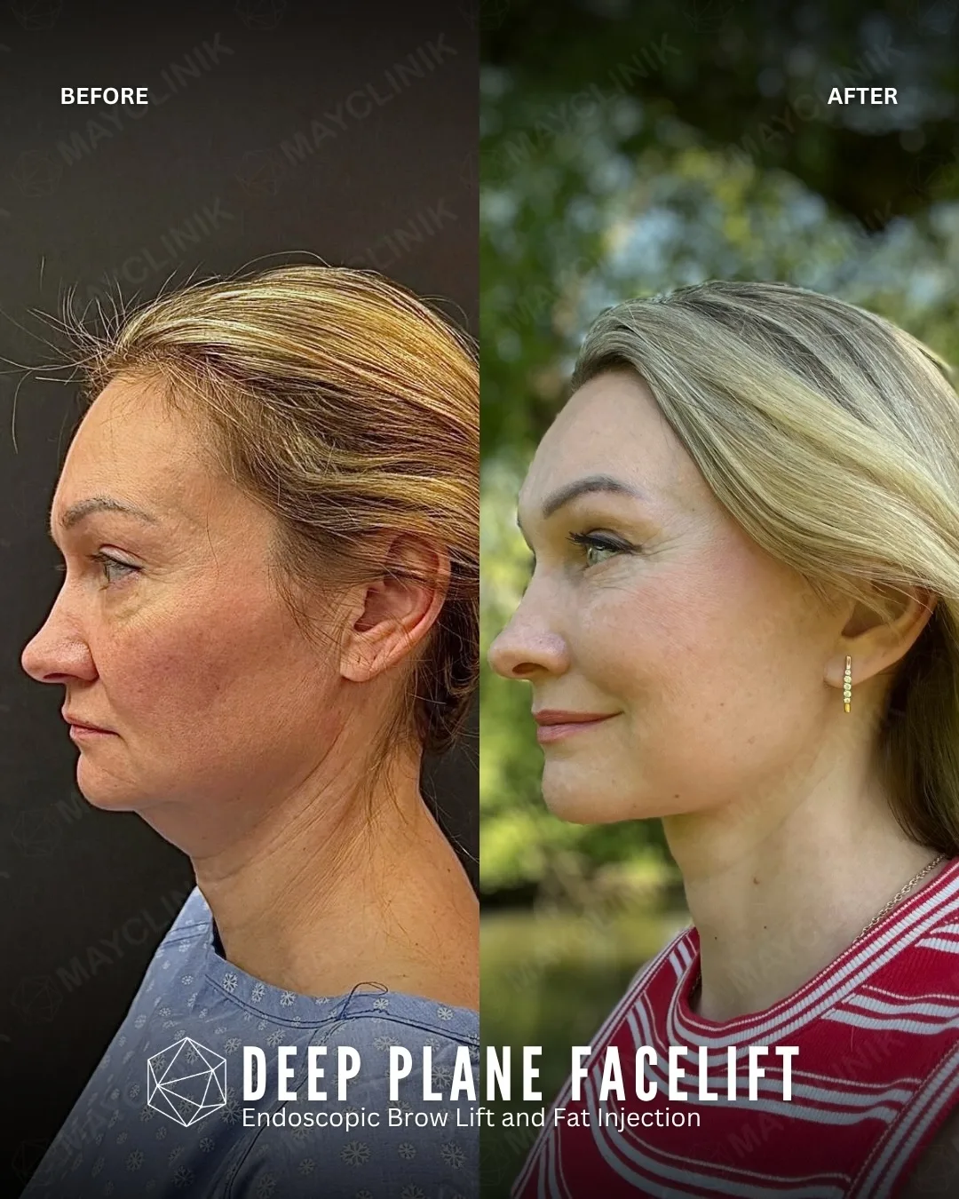 Before and after deep plane facelift — 52-year-old woman, left profile view, 3mo post-op by Dr. Şafak Çakır