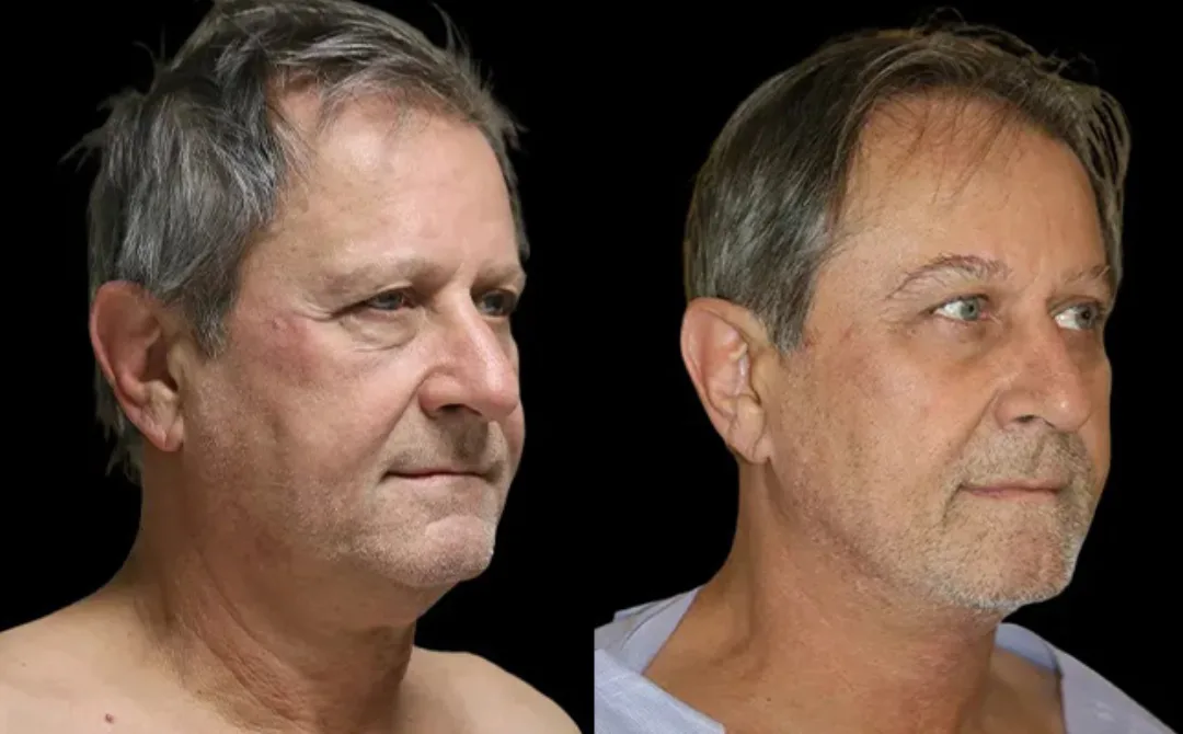 Before and after deep plane facelift — 58-year-old man, right profile view, 6mo post-op by Dr. Sahar Nadimi