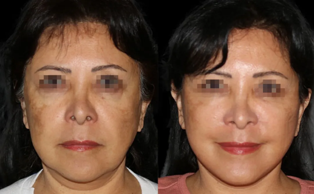 Before and after deep plane facelift — 55-year-old woman, frontal view, 6mo post-op by Dr. Sahar Nadimi