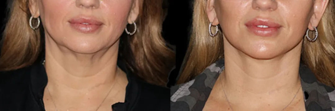 Before and after deep plane facelift — 45-year-old woman, frontal view, 6mo post-op by Dr. Sahar Nadimi