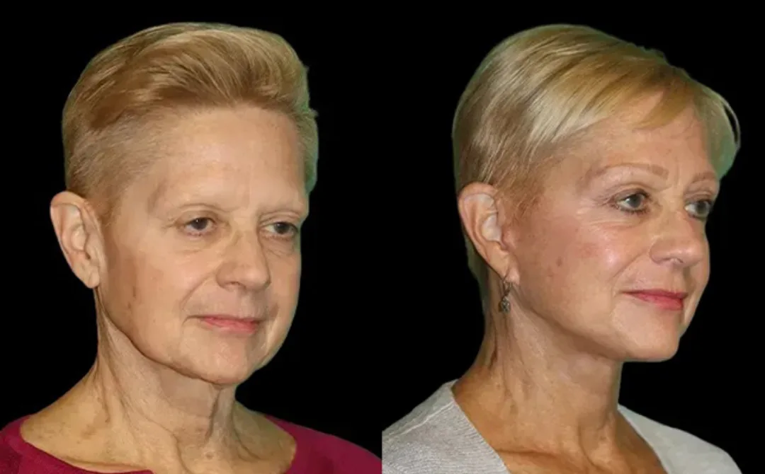 Before and after deep plane facelift — 58-year-old woman, oblique right view, 6mo post-op by Dr. Sahar Nadimi