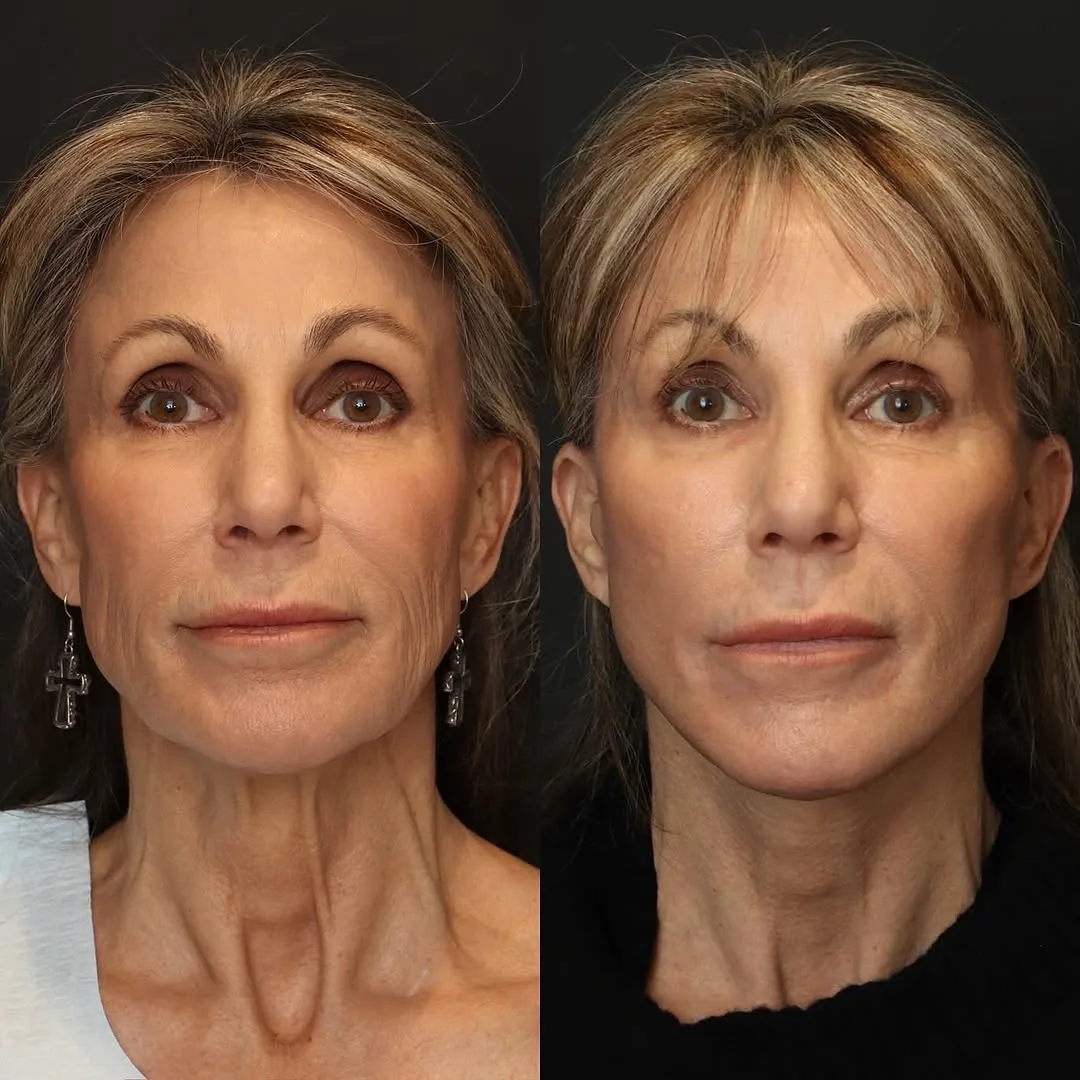 Before and after deep plane facelift — 58-year-old woman, frontal view, 1mo post-op by Dr. Sam DeVictor