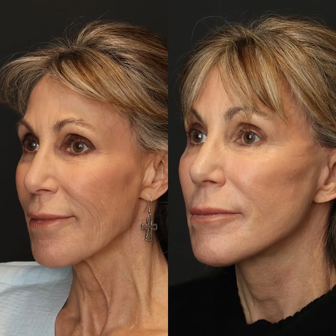 Before and after deep plane facelift — 55-year-old woman, three-quarter view, 1mo post-op by Dr. Sam DeVictor