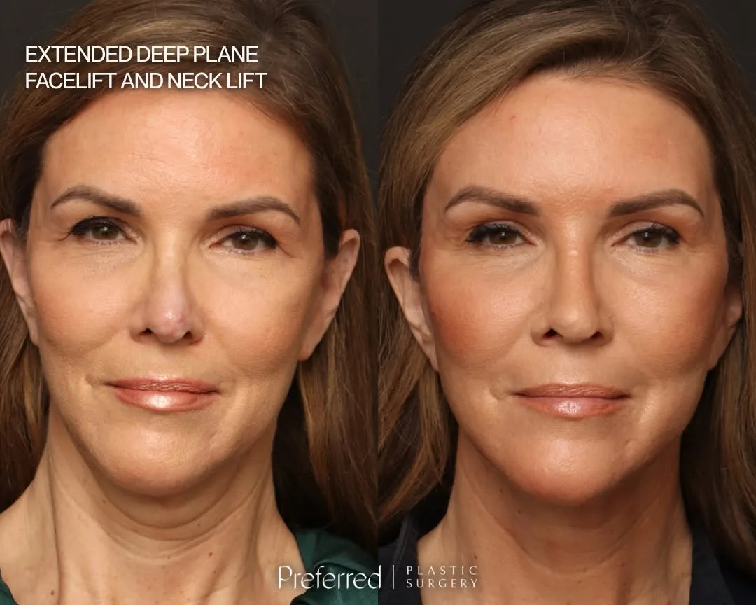 Before and after deep plane facelift — 54-year-old woman, frontal view, 7mo post-op by Dr. Sam DeVictor