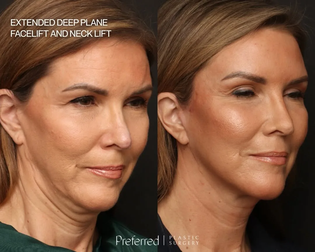 Before and after deep plane facelift — 58-year-old woman, three-quarter view, 8mo post-op by Dr. Sam DeVictor