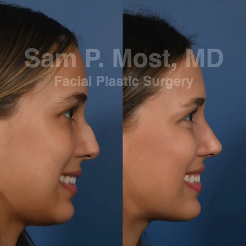 Before and after — Dr. Sam Most