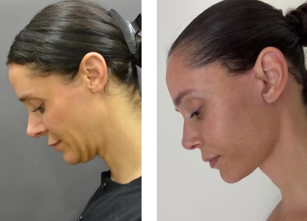 Before and after deep plane facelift — 41-year-old woman, left profile view, 6mo post-op by Dr. Sam Rizk