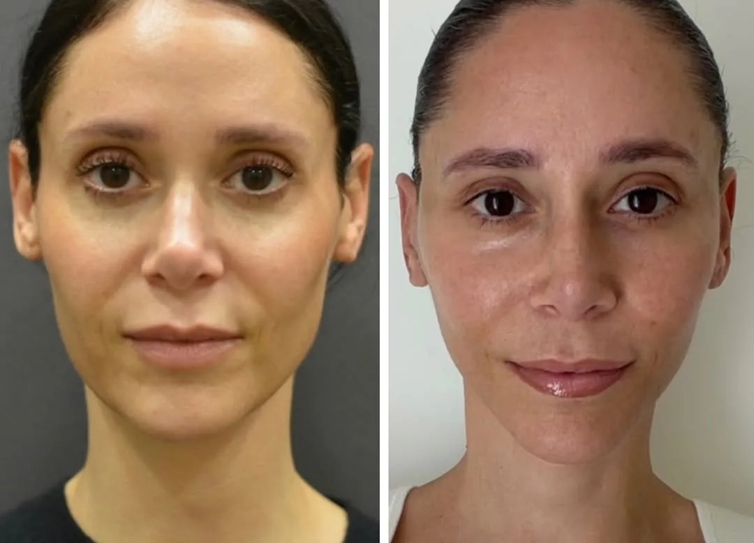 Before and after deep plane facelift — 41-year-old woman, frontal view, 6mo post-op by Dr. Sam Rizk