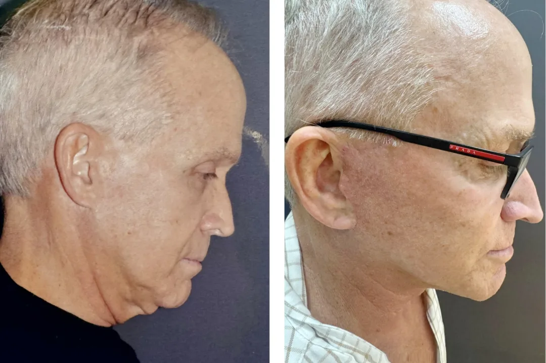 Before and after deep plane facelift — 65-year-old woman, left profile view, 6mo post-op by Dr. Sam Rizk
