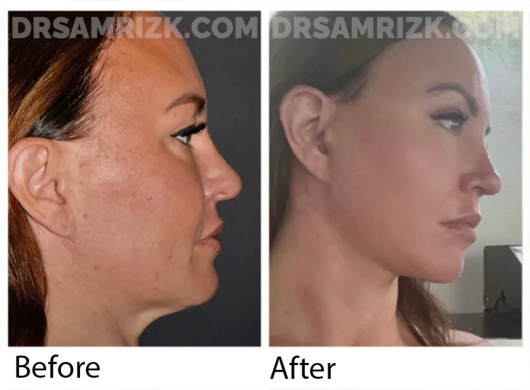 Before and after deep plane facelift — 45-year-old woman, right profile view, 6mo post-op by Dr. Sam Rizk