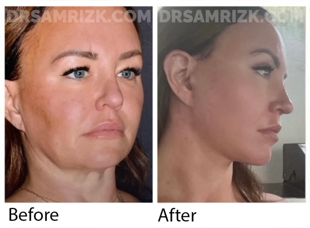 Before and after deep plane facelift — 45-year-old woman, right profile view, 6mo post-op by Dr. Sam Rizk