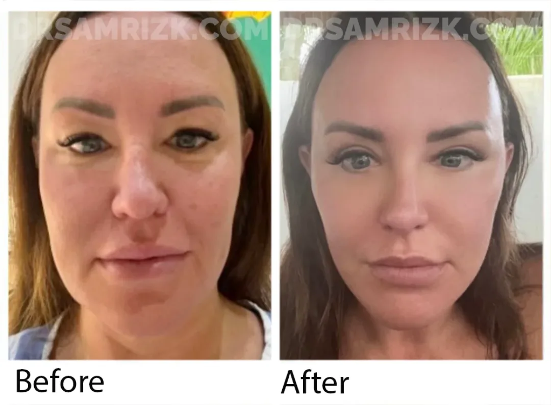 Before and after deep plane facelift — 45-year-old woman, frontal view, 6mo post-op by Dr. Sam Rizk