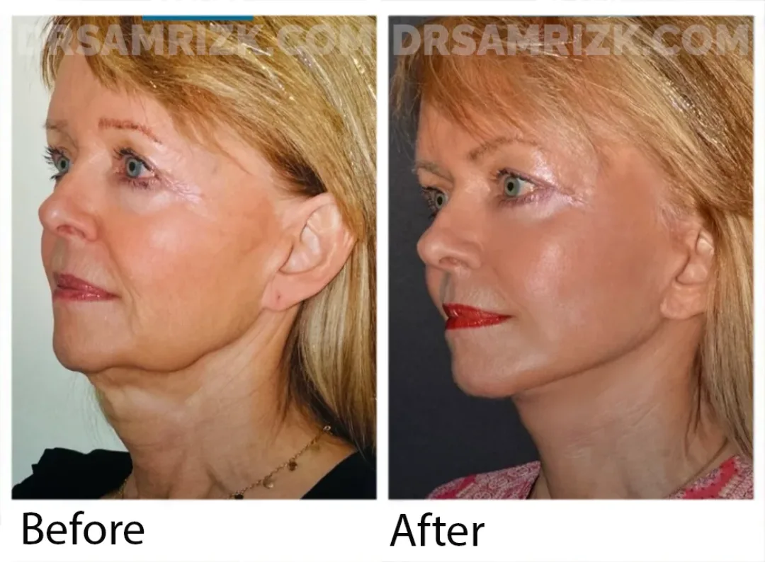 Before and after deep plane facelift — 58-year-old woman, left profile view, 7mo post-op by Dr. Sam Rizk