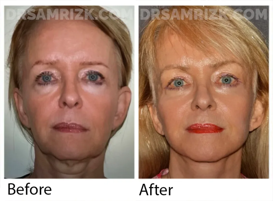 Before and after deep plane facelift — 55-year-old woman, frontal view, 6mo post-op by Dr. Sam Rizk
