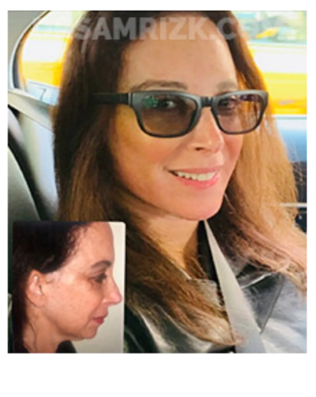 Before and after deep plane facelift — 42-year-old woman, oblique right view, 6mo post-op by Dr. Sam Rizk