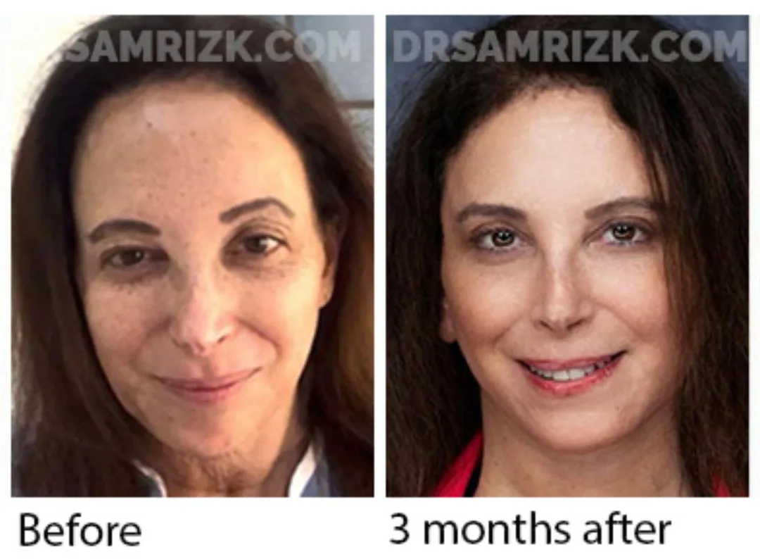 Before and after deep plane facelift — 48-year-old woman, three-quarter view, 3mo post-op by Dr. Sam Rizk