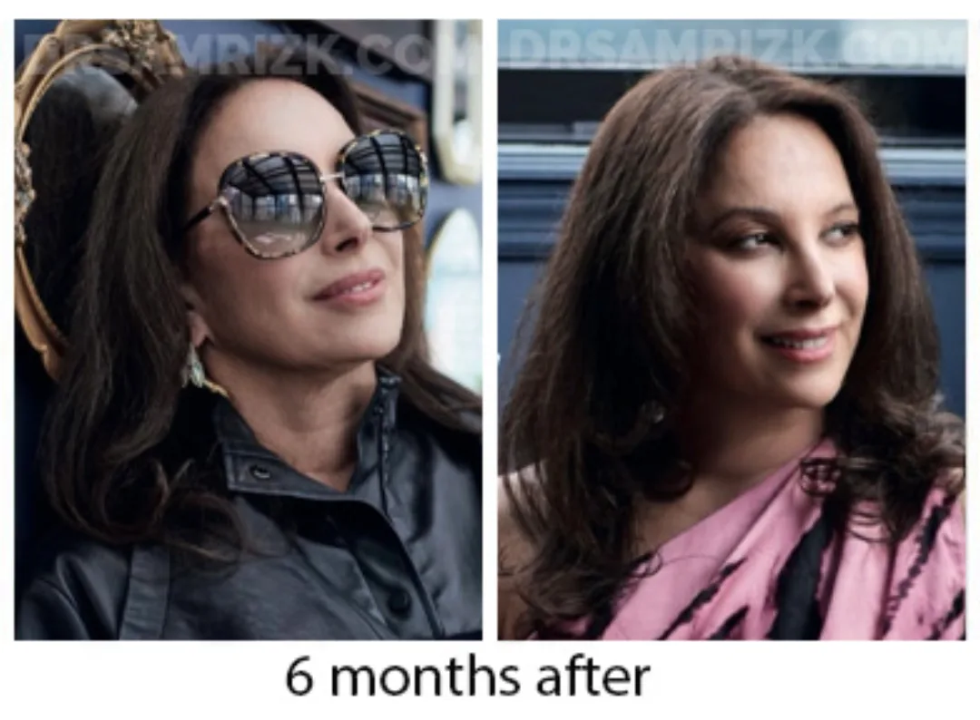 Before and after deep plane facelift — 38-year-old woman, oblique left view, 6mo post-op by Dr. Sam Rizk