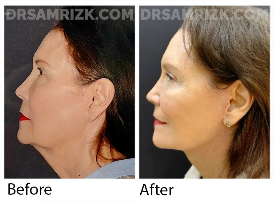 Before and after deep plane facelift — 55-year-old woman, left profile view, 6mo post-op by Dr. Sam Rizk