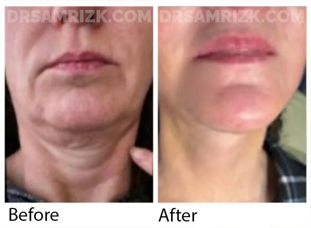 Before and after deep plane facelift — 55-year-old woman, oblique right view, 6mo post-op by Dr. Sam Rizk
