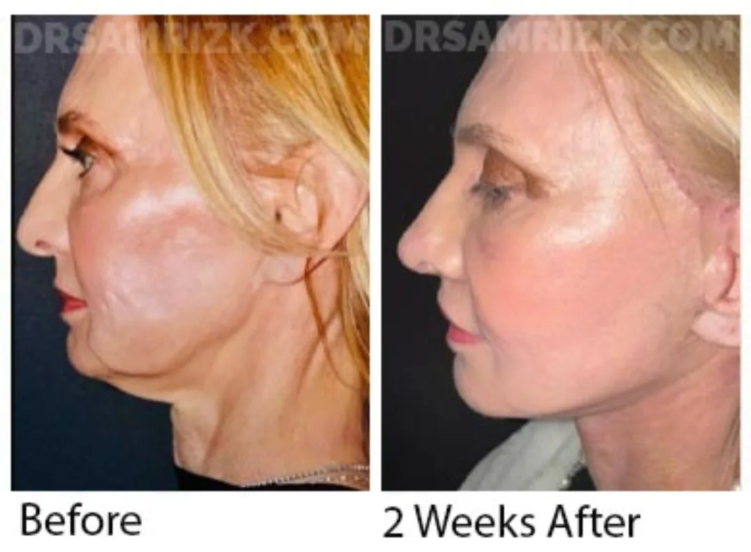 Before and after deep plane facelift — 52-year-old woman, left profile view, 2mo post-op by Dr. Sam Rizk