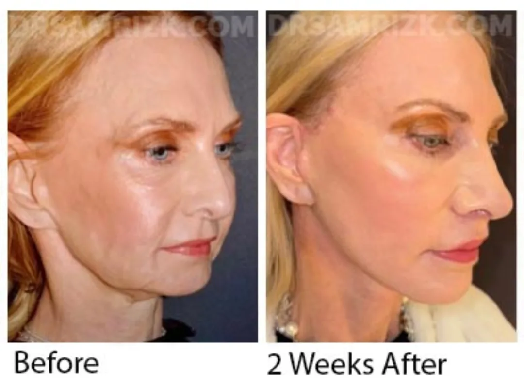 Before and after deep plane facelift — 52-year-old woman, right profile view, 2mo post-op by Dr. Sam Rizk