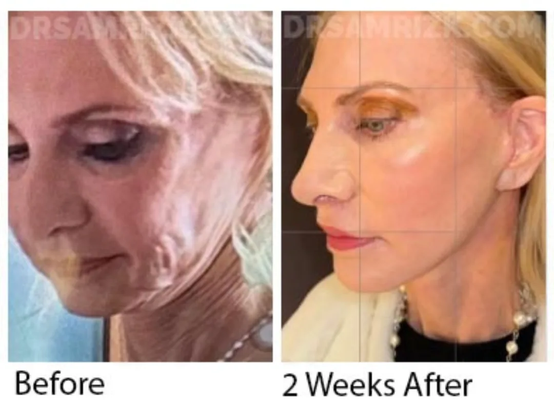 Before and after deep plane facelift — 55-year-old woman, right profile view, 2mo post-op by Dr. Sam Rizk