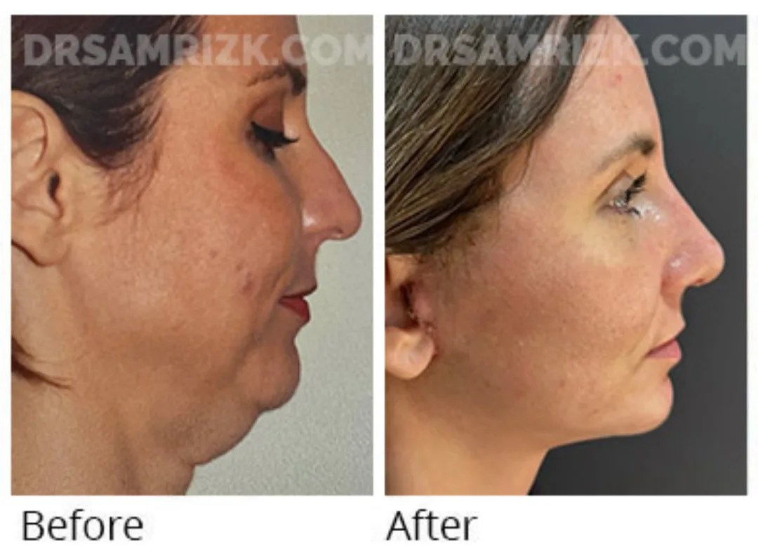 Before and after deep plane facelift — 55-year-old woman, right profile view, 6mo post-op by Dr. Sam Rizk