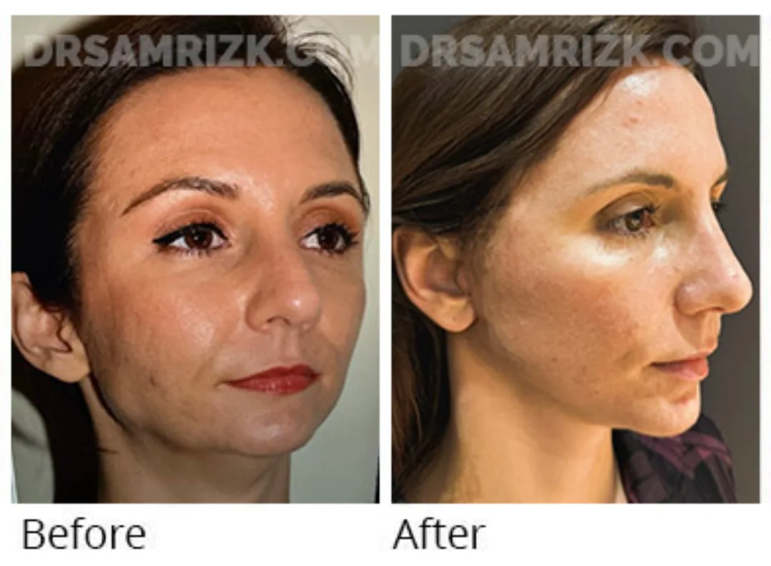 Before and after deep plane facelift — 45-year-old woman, right profile view, 6mo post-op by Dr. Sam Rizk