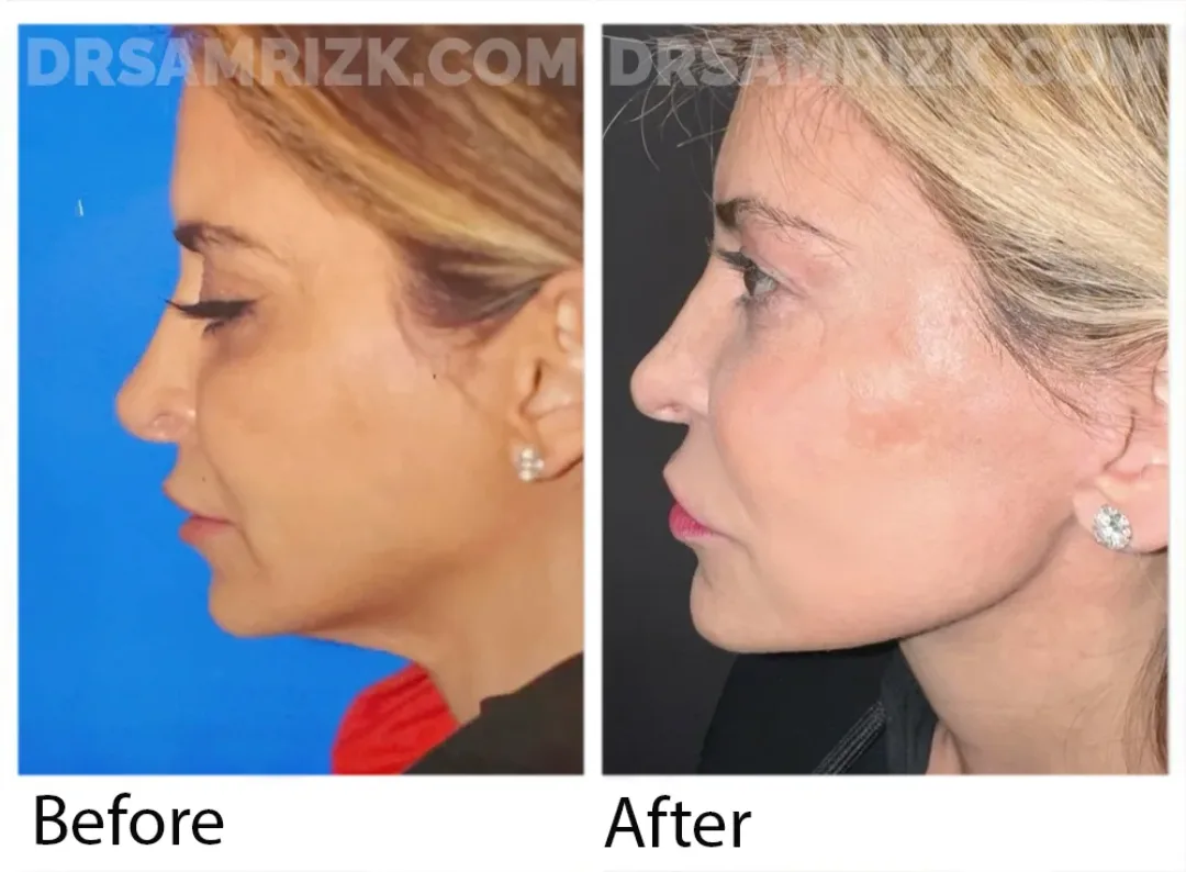 Before and after deep plane facelift — 45-year-old woman, left profile view, 6mo post-op by Dr. Sam Rizk