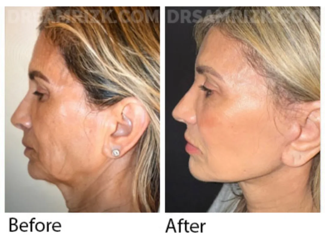 Before and after deep plane facelift — 52-year-old woman, left profile view, 6mo post-op by Dr. Sam Rizk