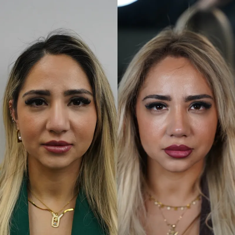 Before and after — Dr. Samet Farasoğlu