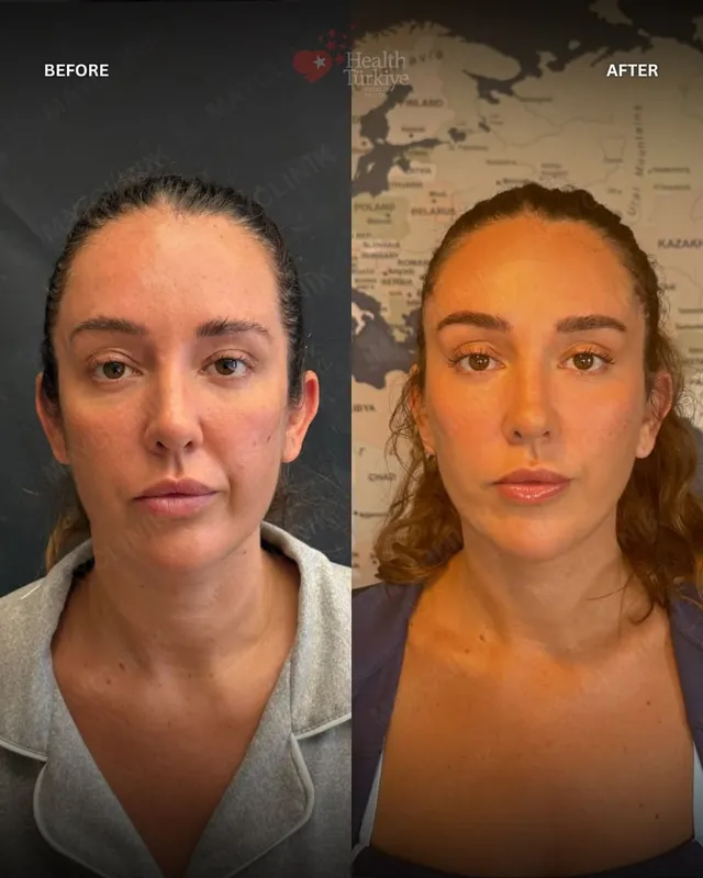 Before and after — Dr. Samet Şendur