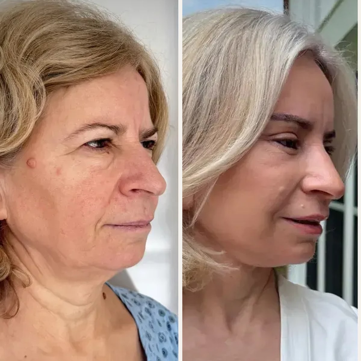 Before and after: Dr. Şamil Yazgan