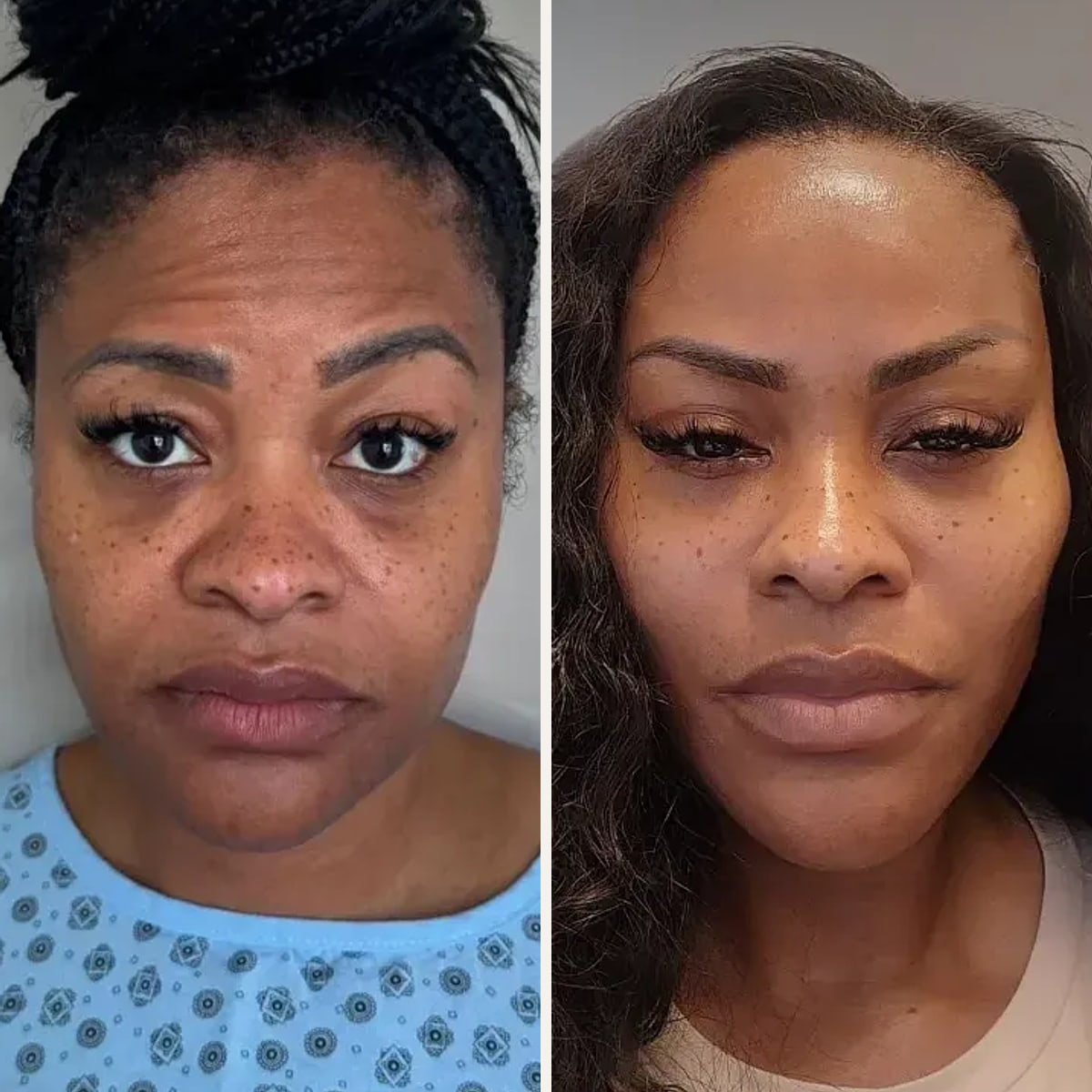 Before and after: Dr. Şamil Yazgan