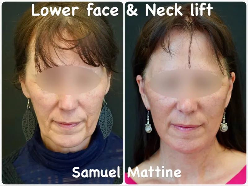 Before and after: Dr. Samuel Mattine