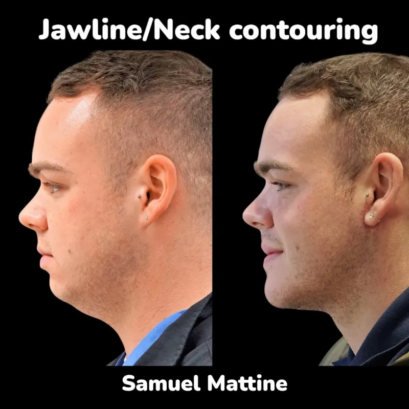 Before and after — Dr. Samuel Mattine