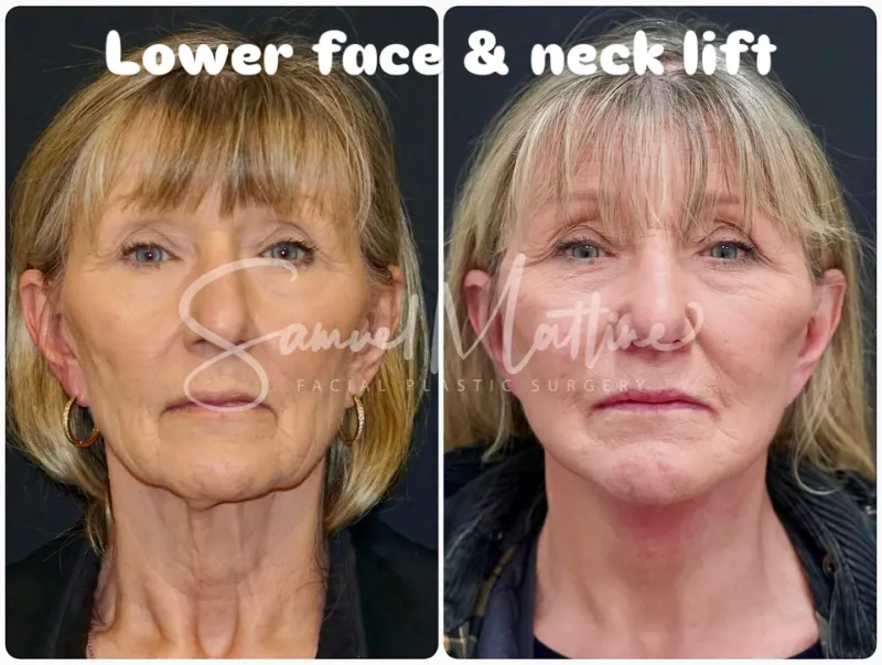 Before and after: Dr. Samuel Mattine