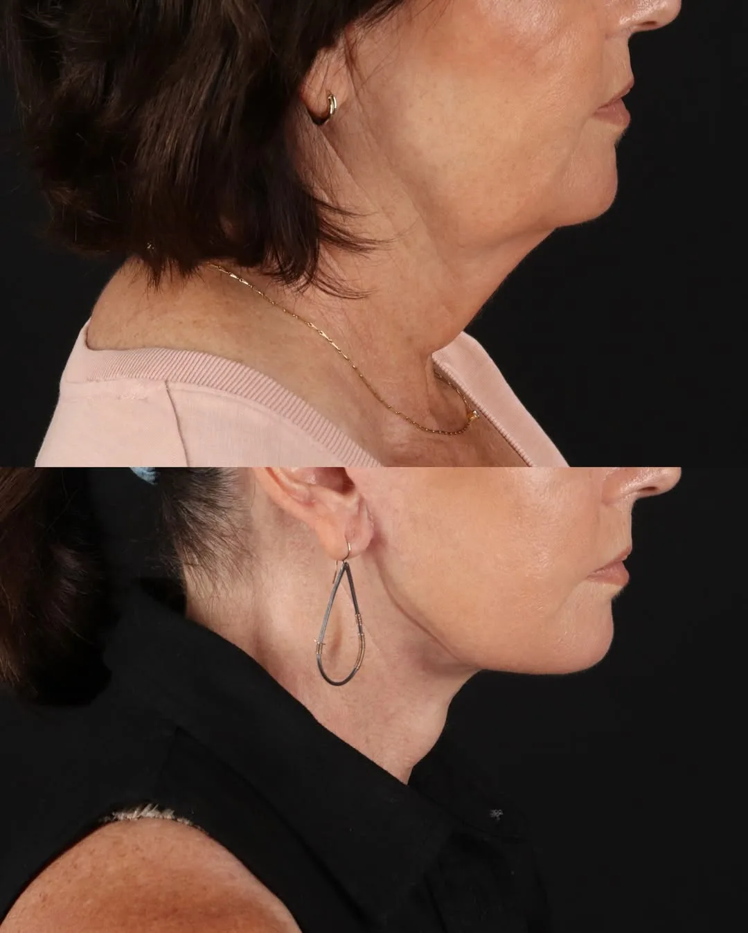 Before and after — Dr. Sanaz Harirchian