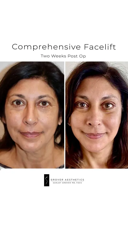 Before and after deep plane facelift, frontal view by Dr. Sanjay Grover