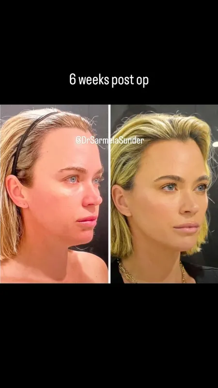 Before and after deep plane facelift — -1-year-old patient, frontal view by Dr. Sarmela Sunder