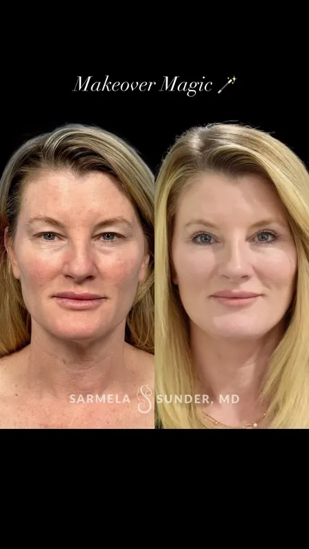 Before and after deep plane facelift — -1-year-old patient, frontal view by Dr. Sarmela Sunder