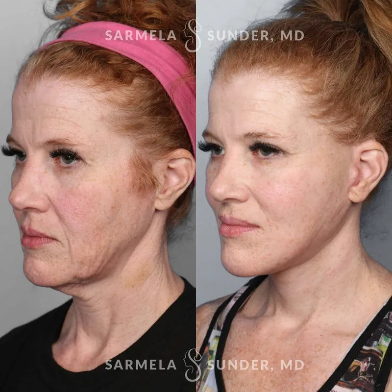 Before and after deep plane facelift — -1-year-old patient, frontal view by Dr. Sarmela Sunder