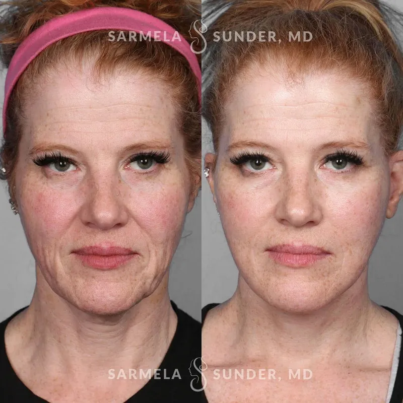 Before and after deep plane facelift — -1-year-old patient, frontal view by Dr. Sarmela Sunder