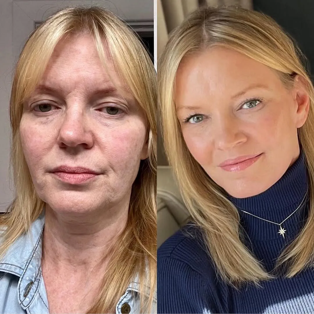 Before and after deep plane facelift — 51-year-old woman, oblique left view, 3mo post-op by Dr. Sean Alemi